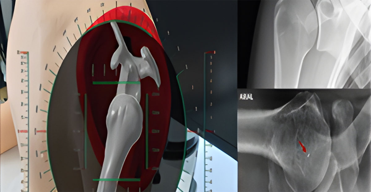 Orthopedic Artificial Joint Replacement
